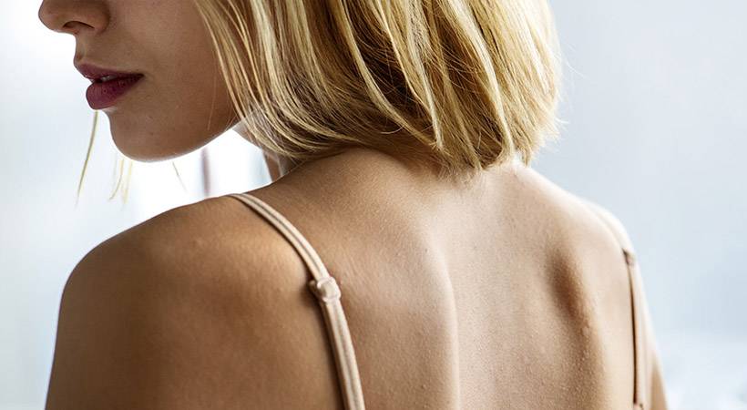 Kako se spopasti z mozolji na hrbtu, dekolteju in ostalih delih telesa